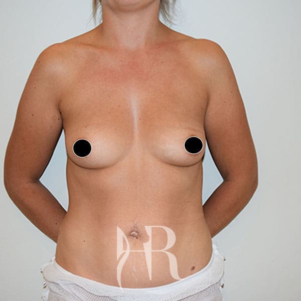 HR Plastic Surgery - Breast Enlargement patient before 1